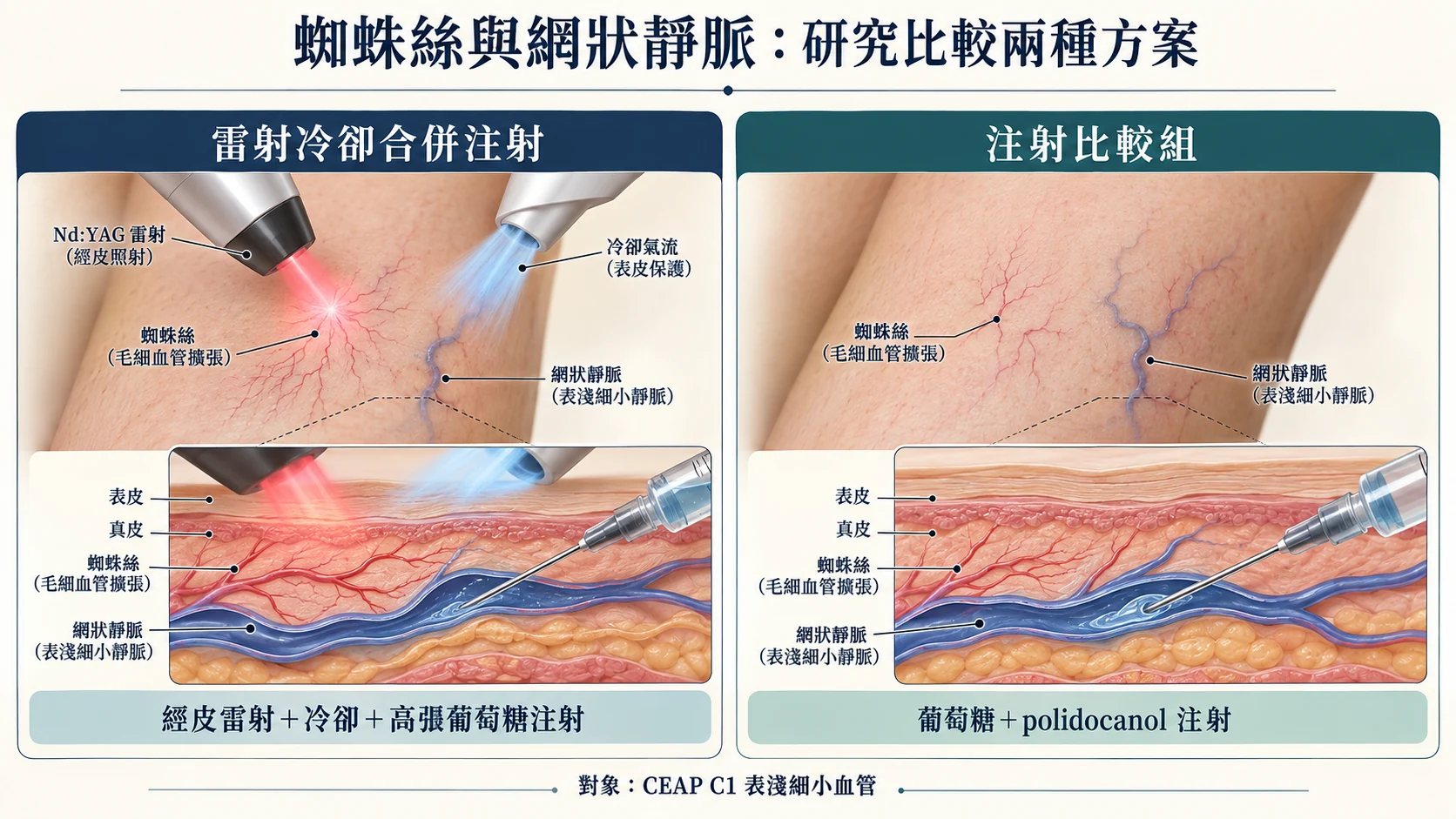 雷射冷卻合併注射與傳統注射比較:經皮雷射、冷卻氣流及細針注入表淺網狀靜脈的研究示意
