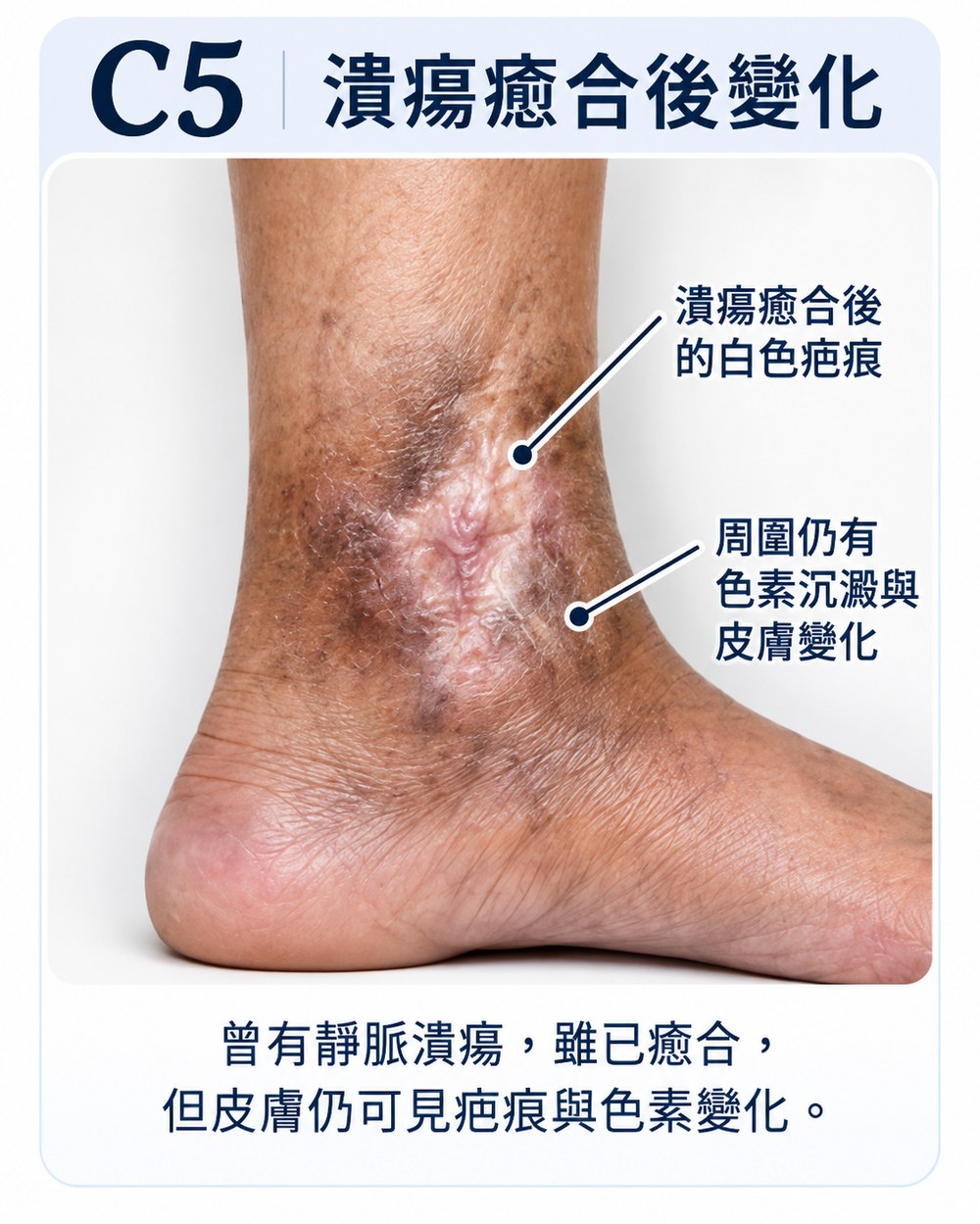靜脈曲張第五期 C5：腳踝內側潰瘍癒合後留下白色疤痕，周圍仍有色素沉澱與皮膚變化。