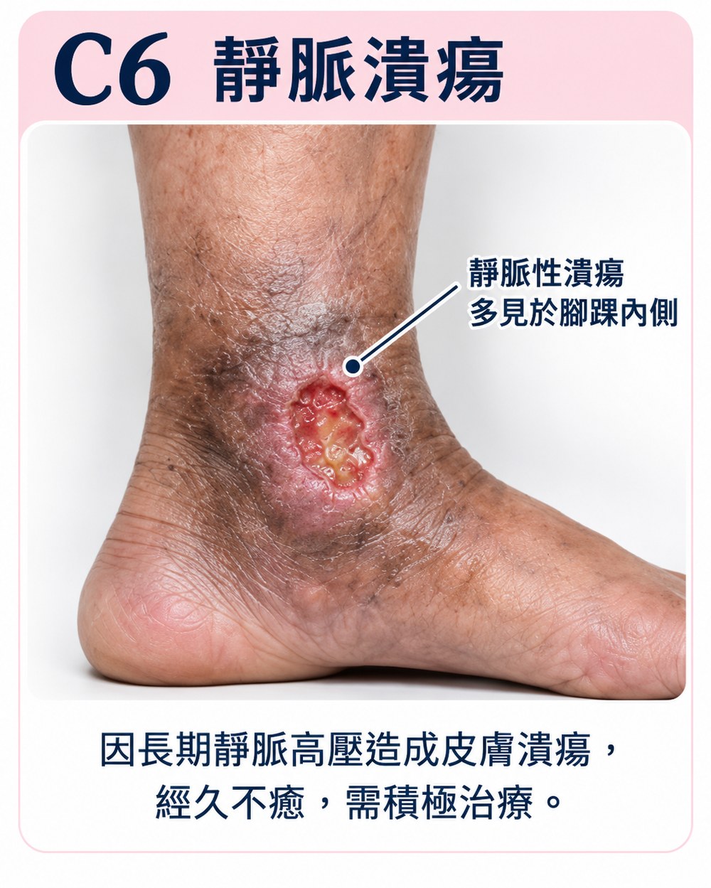 靜脈曲張第六期 C6：腳踝內側出現活動性靜脈潰瘍，因長期靜脈高壓造成皮膚潰瘍、經久不癒。