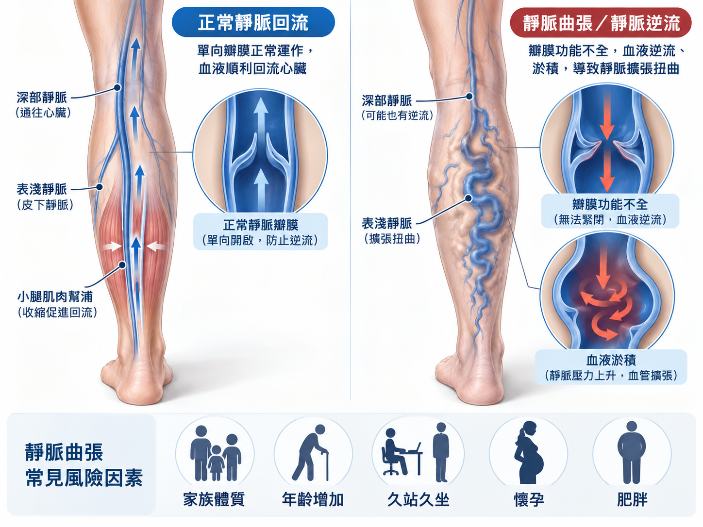 正常靜脈回流與靜脈曲張逆流比較圖，呈現靜脈瓣膜、小腿肌肉幫浦、血液逆流與靜脈淤積，以及常見風險因素。